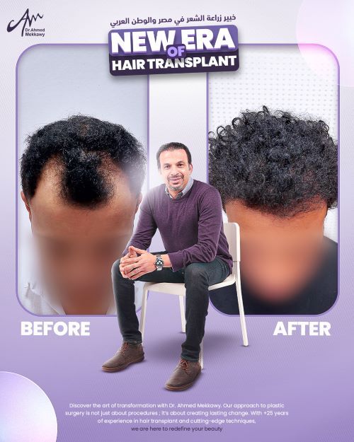 ما هي أفضل تقنيات زراعة الشعر في مصر؟